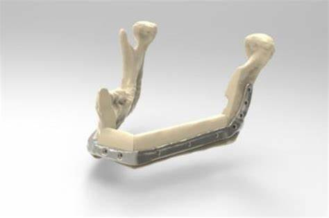 3D打印PEEK及復合材料在口腔醫(yī)學領(lǐng)域的研究進展 3D打印PEEK及復合材料在口腔醫(yī)學領(lǐng)域的研究進展