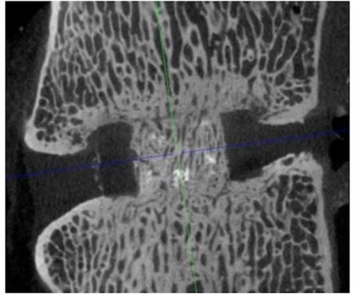 Locate Bio公司的骨修复新技术