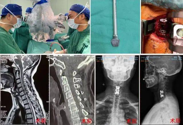 首次将新型3D打印钽金属椎间融合器应用于脊柱手术