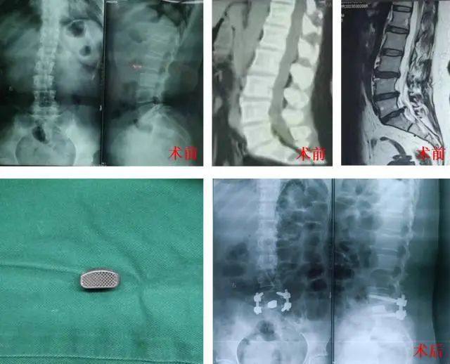 首次将新型3D打印钽金属椎间融合器应用于脊柱手术