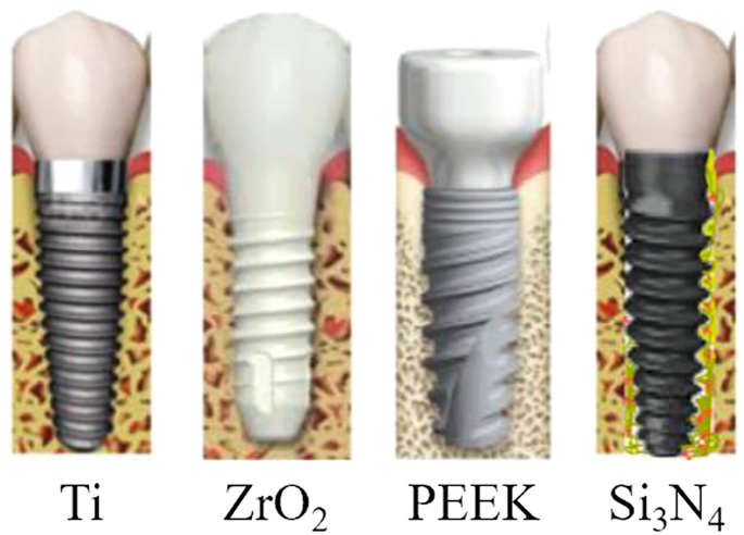 Silicon Nitride for Dental Applications | SpringerLink