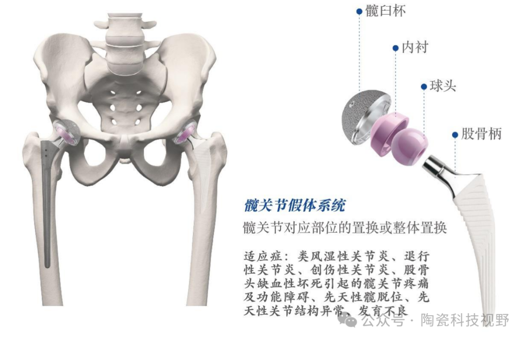 人工髋关节材料：金属、高分子、陶瓷