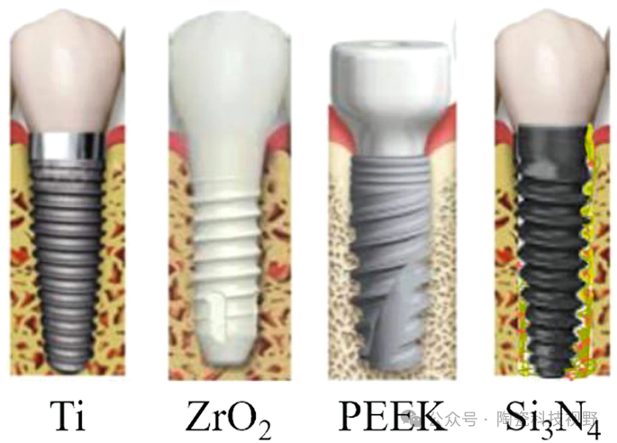 极具前景的牙科种植体材料——氮化硅陶瓷