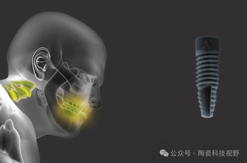 极具前景的牙科种植体材料——氮化硅陶瓷